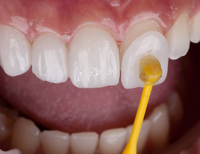 Dental laminate