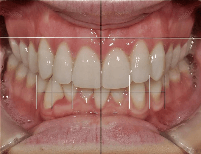 smile design