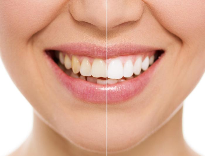 هزینه طرح لبخند