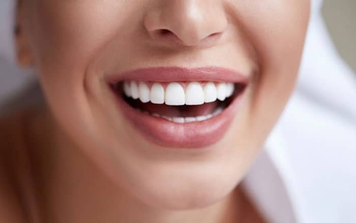 لمینت دندان