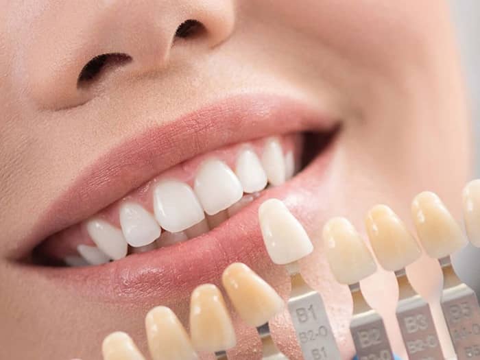 لیمنت دندان تهران